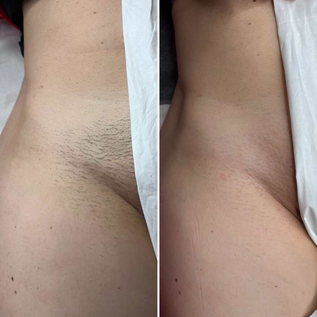 Hair removal