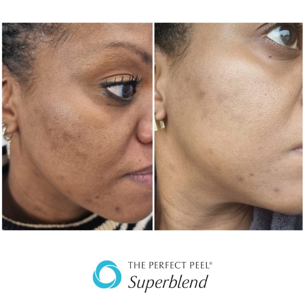 6 weeks after 1 peel