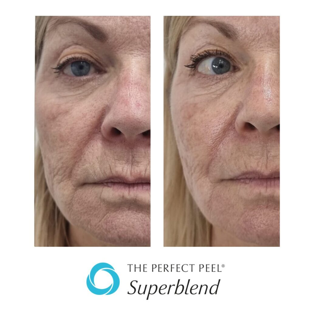 TPP Superblend 3 treatments