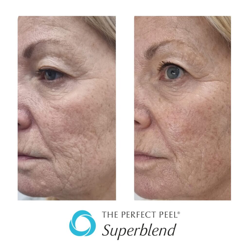 TPP Superblend Before After 3 Treatments