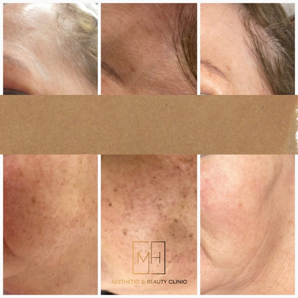 Pigmentation