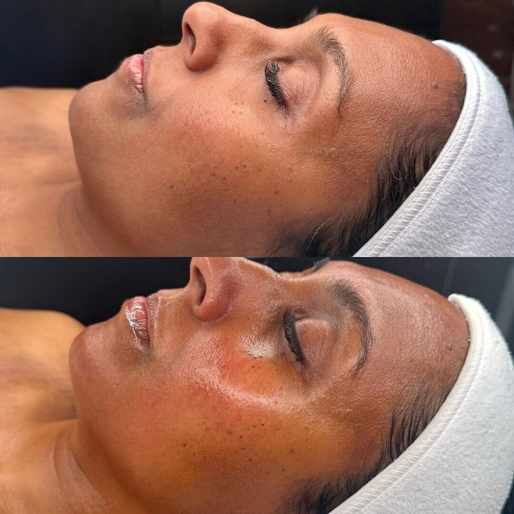 Signature Hydrafacial + Dermaplaning (1)