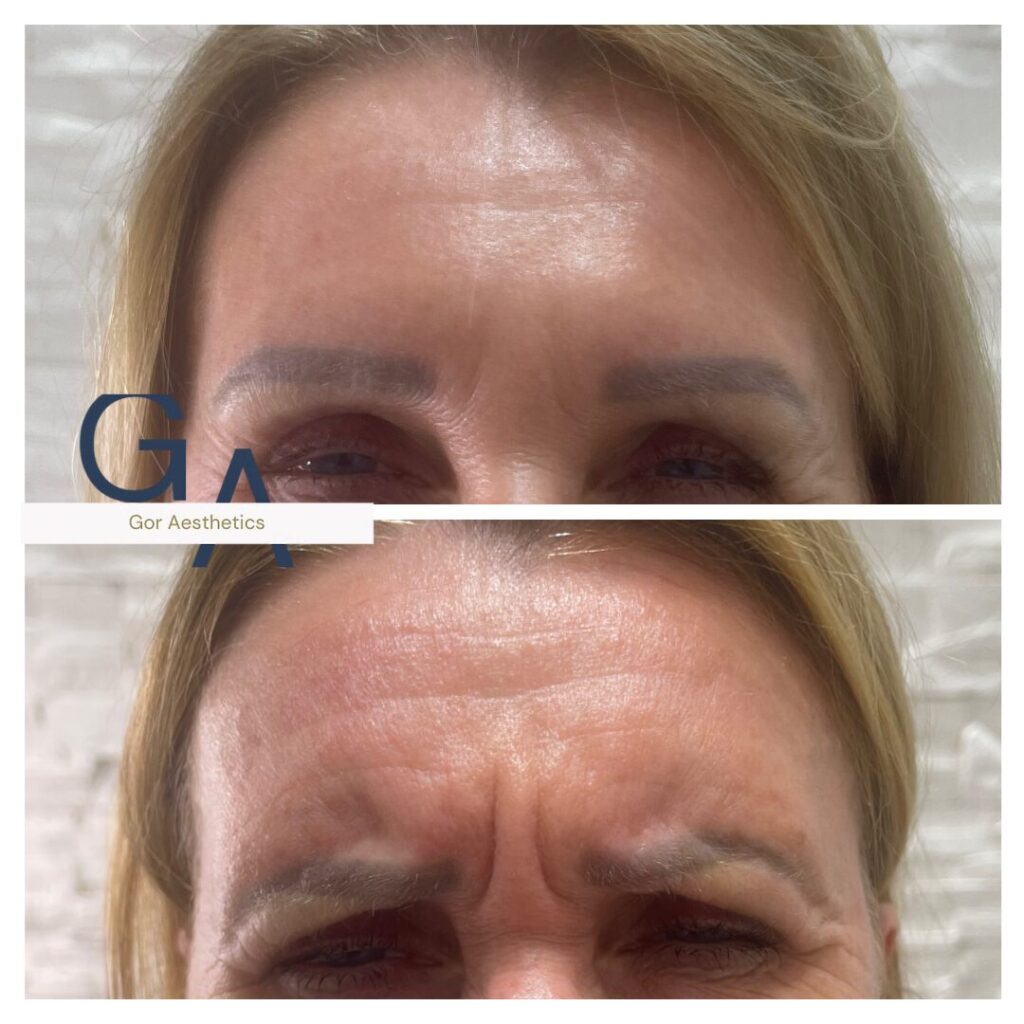 Signature Hydrafacial + Dermaplaning (2)