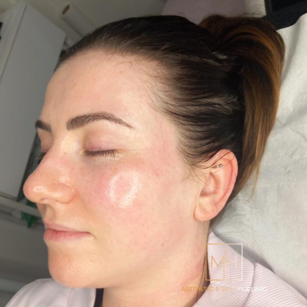 Signature Hydrafacial + Dermaplaning